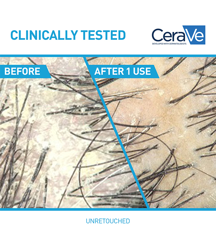 cerave-antidandruffhydratingshampoo-12oz-us-clinicals_1_700x785_v1-1.jpg